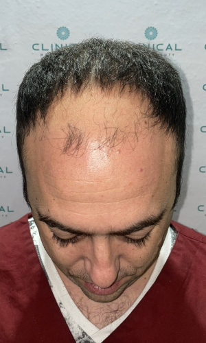 Antes